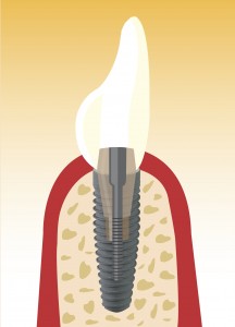 Grafik Implantat; Quelle: proDente